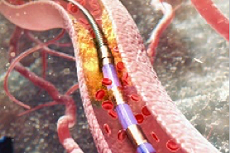 혈관 속 자성 가이드와이어 마이크로로봇. 아임시스템 제공